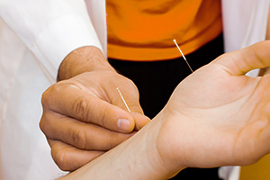 Physiotherapist performing acupuncture on a patient